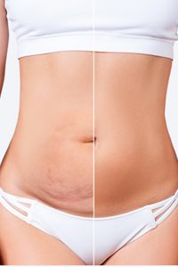 Abdominal Liposuction and Tummy Tuck 