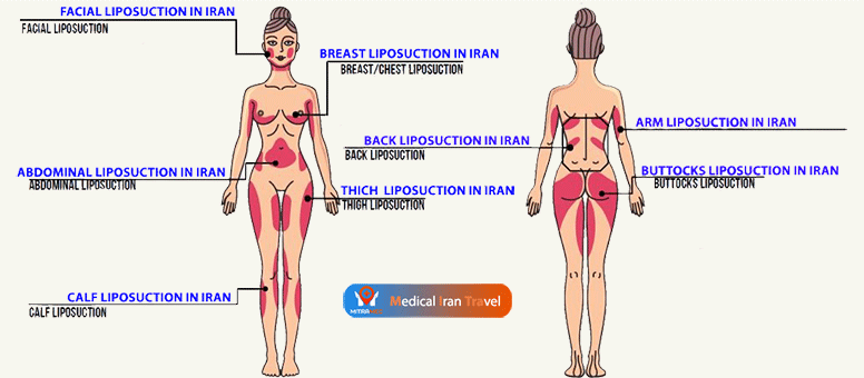 Liposuction surgery in Iran